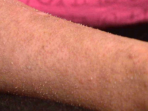 Dày sừng nang lông - Hình ảnh minh họa